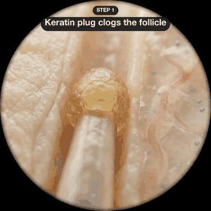 Keratolyse Protocol mechanism animation — Lactic+Urea dissolving the plug, Niacinamide quieting the redness, Centella sealing the lipid barrier