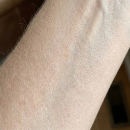 Sharon's forearm — before (pale)