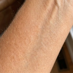 Sharon's forearm — after, golden tan