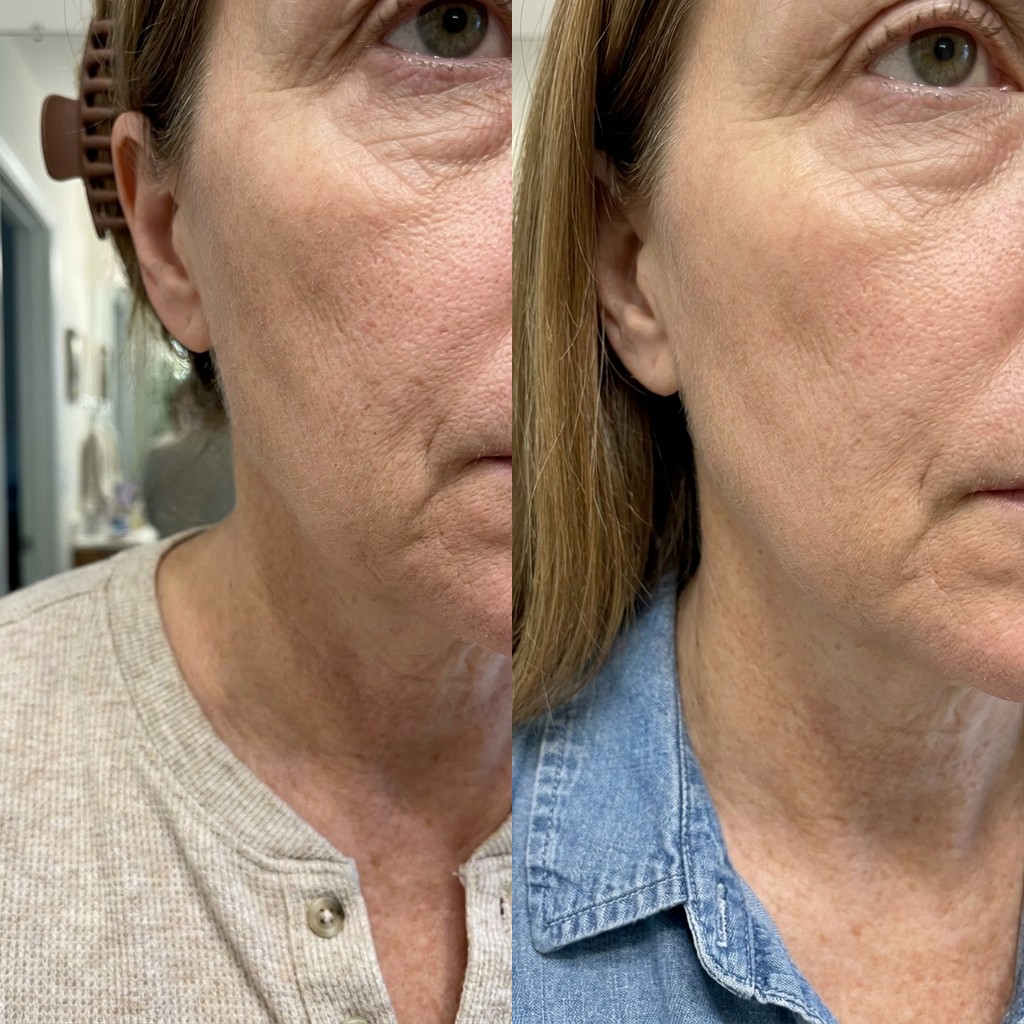 Dermalyse before and after — under-eye wrinkles, day 1 vs result