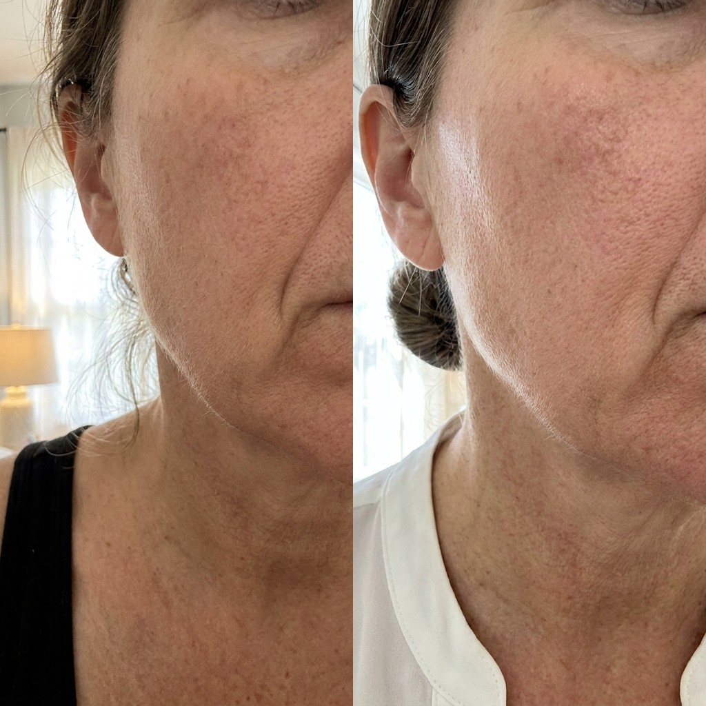 Dermalyse before and after — smile lines wrinkles, day 1 vs result