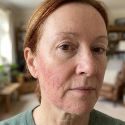 Sharon's cheek — before (eczema flare)