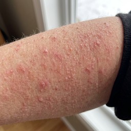 Sharon's upper arm — before (KP bumps)