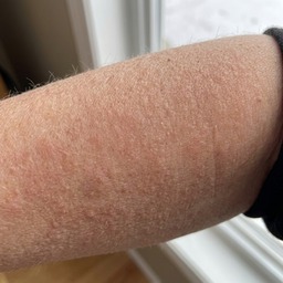 Sharon's upper arm — after, smooth