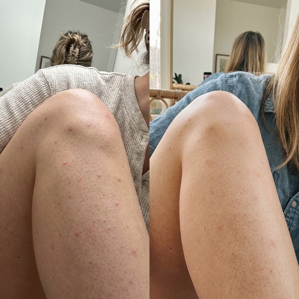 Keratolyse before and after — calf keratosis pilaris, day 1 vs day 30
